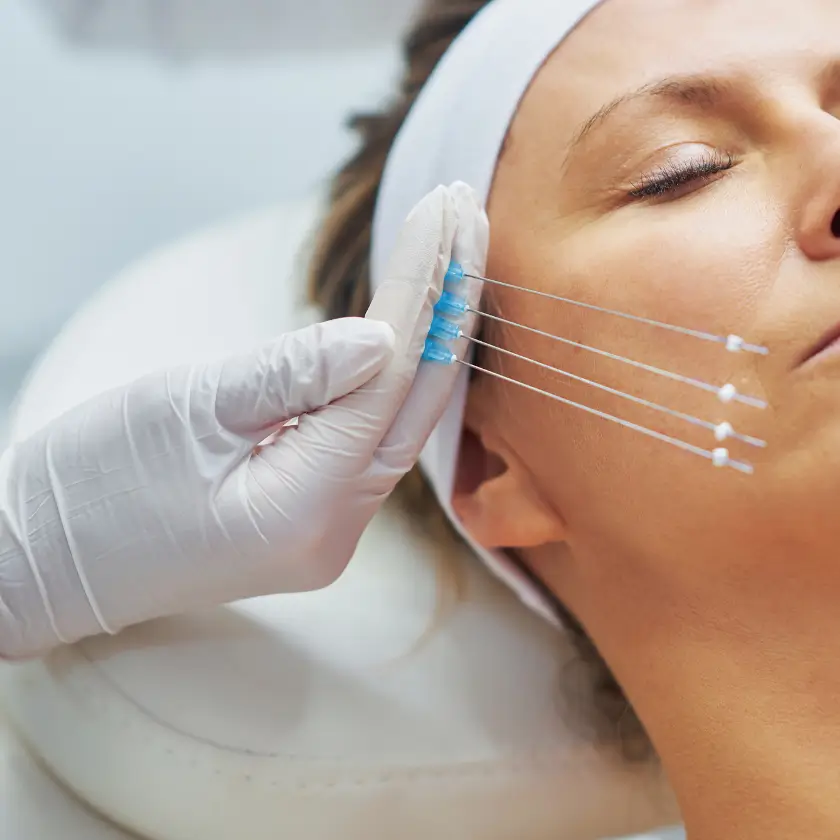 Tratamiento de hilos tensores - Bioestimulación